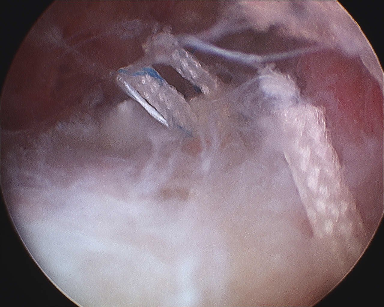 Shoulder PASTA Repair Knots Tied Subacromial Space